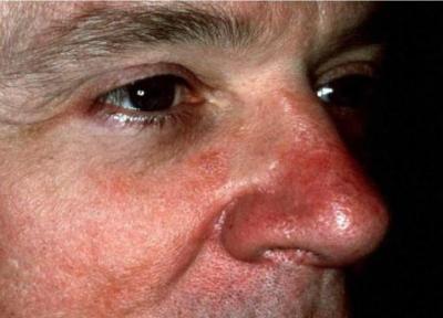 بیماری رینوفیما بیماری رینوفیما